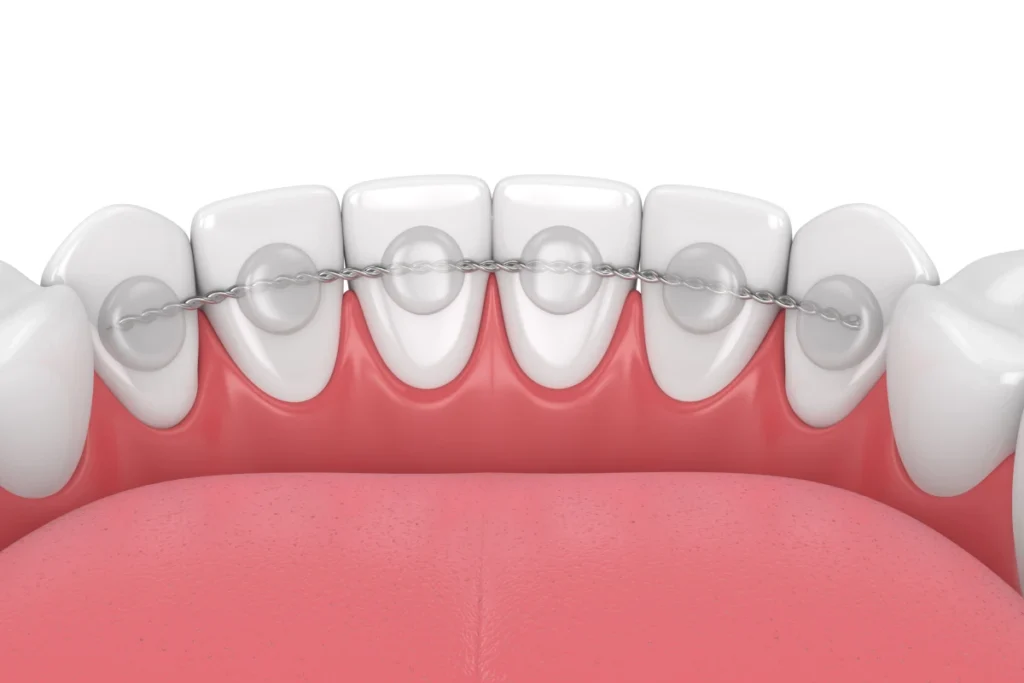 aligneur contention geneve