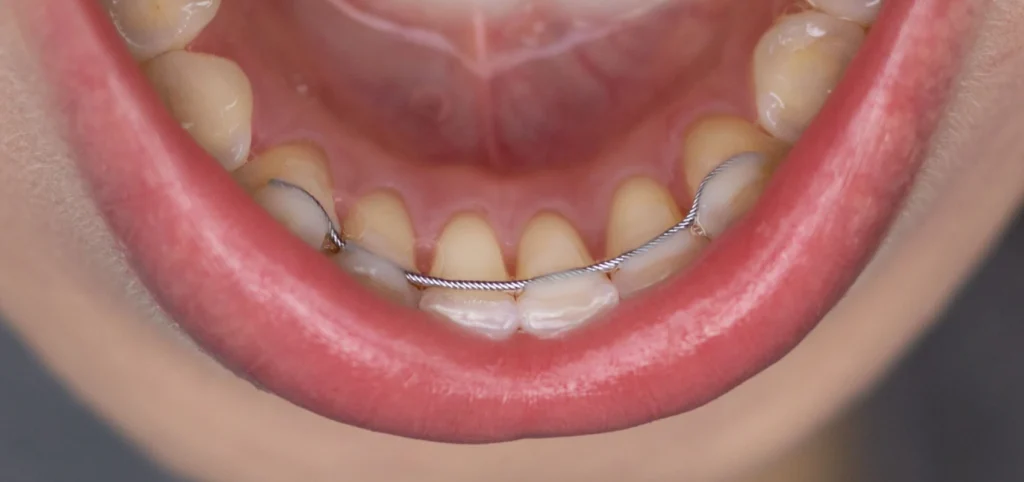 contention fixe geneve