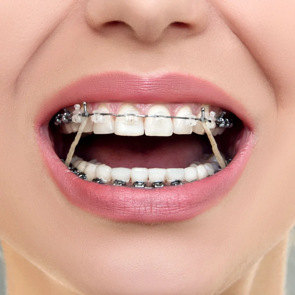 elastiques orthodontie douvaine geneve