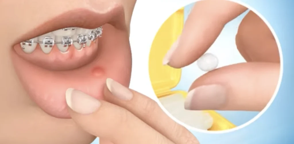 cire orthodontie bagues geneve